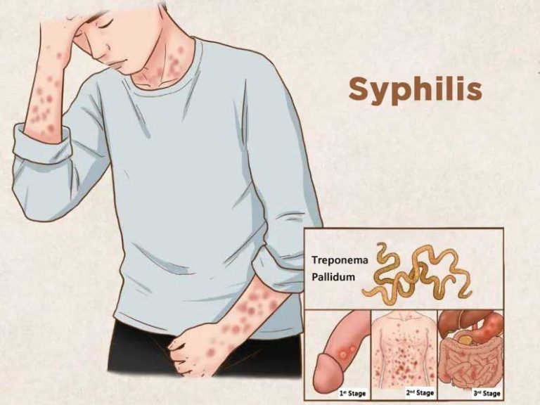Topek Problem Topeka/Shawnee County tops state for syphilis as area confronts ...